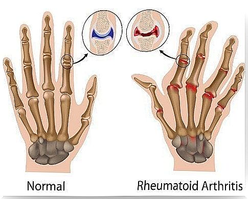 Rheumatoid arthritis